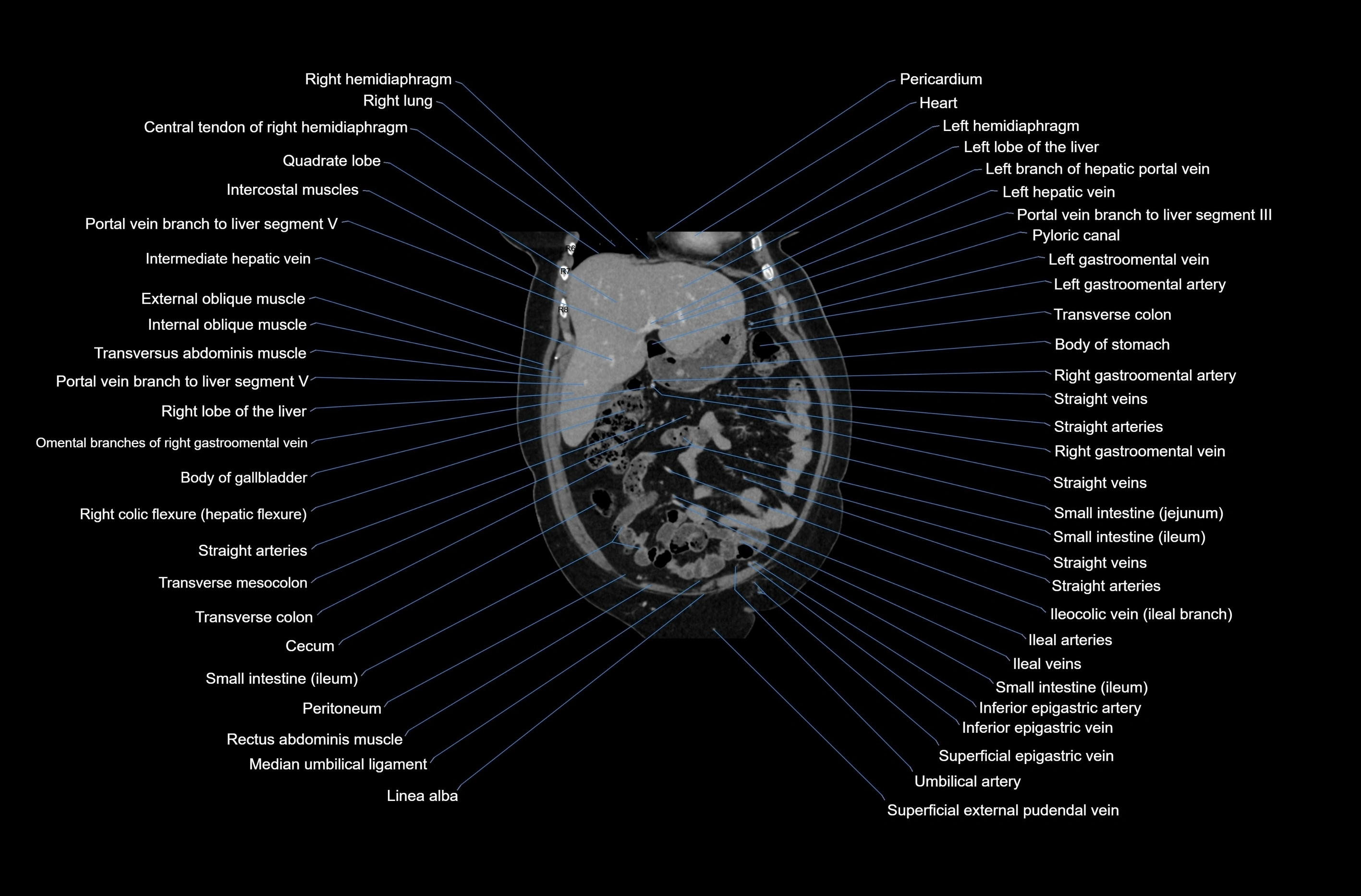 CT abdomen coronal cross sectional anatomy labelled radiology image-00023.webp